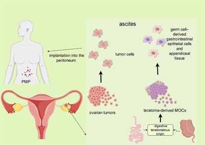 Multimodal diagnostic strategies and precision medicine in mucinous ovarian carcinoma: a comprehensive approach